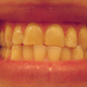 Image for article titled Are You a Nighttime Tooth Grinder? Here's How To Tell—And What to Do About It